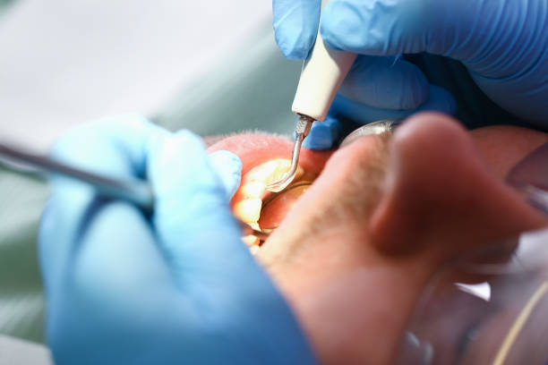 Best Emergency Dentist for Knocked-Out Tooth in Alvord, TX